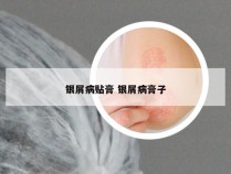 银屑病贴膏 银屑病膏子