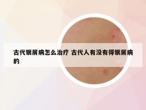 古代银屑病怎么治疗 古代人有没有得银屑病的