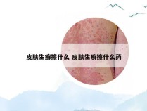 皮肤生癣擦什么 皮肤生癣擦什么药