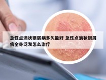 急性点滴状银屑病多久能好 急性点滴状银屑病全身泛发怎么治疗