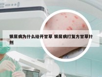 银屑病为什么给开甘草 银屑病打复方甘草针剂