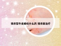 钱币型牛皮癣吃什么药 钱币藓治疗