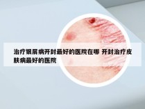治疗银屑病开封最好的医院在哪 开封治疗皮肤病最好的医院