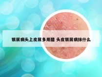 银屑病头上皮屑多用醋 头皮银屑病抹什么