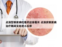 点滴型银屑病吃着药还接着长 点滴状银屑病治疗期间又出现小丘疹