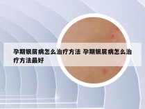 孕期银屑病怎么治疗方法 孕期银屑病怎么治疗方法最好