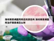 潍坊银屑病医院附近的派出所 潍坊银屑病医院治疗银屑病怎么样