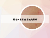眉毛长银屑病 眉毛处长癣