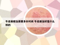 牛皮癣根治需要多长时间 牛皮癣治好是什么样的