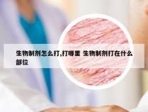 生物制剂怎么打,打哪里 生物制剂打在什么部位