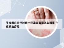 牛皮癣在治疗过程中还发出出是怎么回事 牛皮癣治疗后