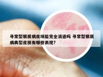 寻常型银屑病皮埙能完全消退吗 寻常型银屑病典型皮损有哪些表现?