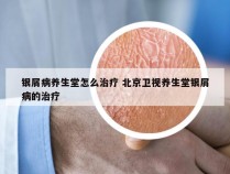 银屑病养生堂怎么治疗 北京卫视养生堂银屑病的治疗