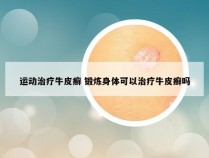 运动治疗牛皮癣 锻炼身体可以治疗牛皮癣吗