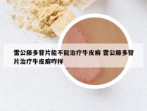 雷公藤多苷片能不能治疗牛皮癣 雷公藤多苷片治疗牛皮癣咋样