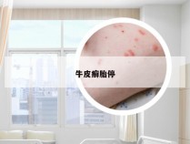 牛皮癣胎停