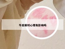 牛皮癣对心理有影响吗