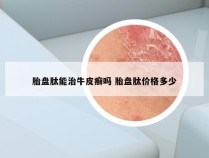 胎盘肽能治牛皮癣吗 胎盘肽价格多少