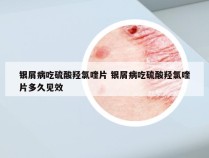 银屑病吃硫酸羟氯喹片 银屑病吃硫酸羟氯喹片多久见效