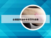 全国医院治好寻常型牛皮癣