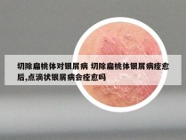 切除扁桃体对银屑病 切除扁桃体银屑病痊愈后,点滴状银屑病会痊愈吗