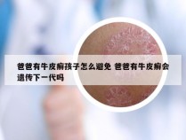 爸爸有牛皮癣孩子怎么避免 爸爸有牛皮癣会遗传下一代吗