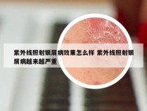 紫外线照射银屑病效果怎么样 紫外线照射银屑病越来越严重