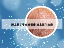 脚上长了牛皮癣很痒 脚上起牛皮癣
