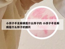 小孩子手足癣病是什么样子的 小孩子手足癣病是什么样子的图片