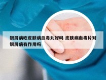 银屑病吃皮肤病血毒丸好吗 皮肤病血毒片对银屑病有作用吗