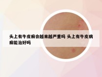 头上有牛皮癣会越来越严重吗 头上有牛皮病癣能治好吗