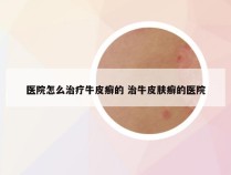 医院怎么治疗牛皮癣的 治牛皮肤癣的医院