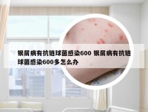 银屑病有抗链球菌感染600 银屑病有抗链球菌感染600多怎么办
