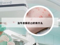 治牛皮癣忌口的有什么