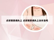 点状银屑病头上 点状银屑病头上会长包吗