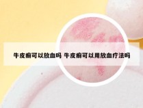 牛皮癣可以放血吗 牛皮癣可以用放血疗法吗
