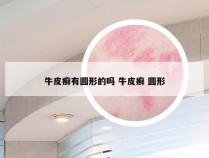 牛皮癣有圆形的吗 牛皮癣 圆形
