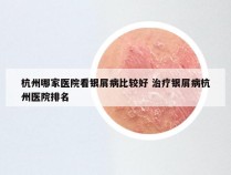 杭州哪家医院看银屑病比较好 治疗银屑病杭州医院排名