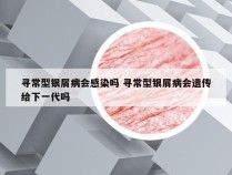 寻常型银屑病会感染吗 寻常型银屑病会遗传给下一代吗