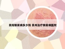 贵阳银屑病多少钱 贵州治疗银屑病医院
