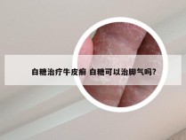 白糖治疗牛皮癣 白糖可以治脚气吗?