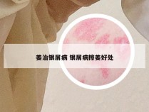 姜治银屑病 银屑病擦姜好处