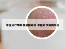 中医治疗银屑病是排毒吗 中医对银屑病根治