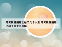 冬天银屑病身上起了几个小点 冬天银屑病身上起了几个小点痒