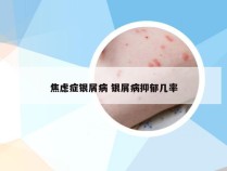 焦虑症银屑病 银屑病抑郁几率