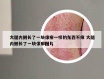 大腿内侧长了一块像癣一样的东西不痒 大腿内侧长了一块像癣图片