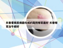 长春看银屑病最权威的医院哪家最好 长春哪家治牛癣好