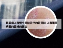 银屑病上海哪个医院治疗的好医院 上海银屑病看的最好的医生