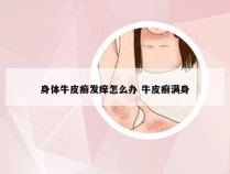 身体牛皮癣发痒怎么办 牛皮癣满身