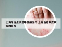 上海专治点滴型牛皮癣治疗 上海治疗牛皮病癣的医院
